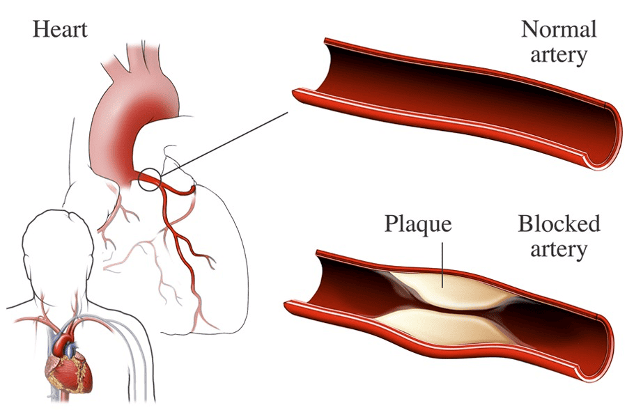 Normal vs blocked artery - Dr. Biprajit Parbat - HEARTVEDA