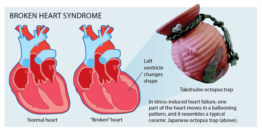 Broken Heart Syndrome - Dr. Biprajit Parbat - HEARTVEDA