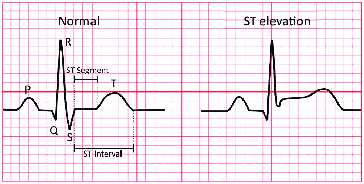 ECG waves - - Dr. Biprajit Parbat - HEARTVEDA